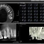 CBCT Endo polje 3×3